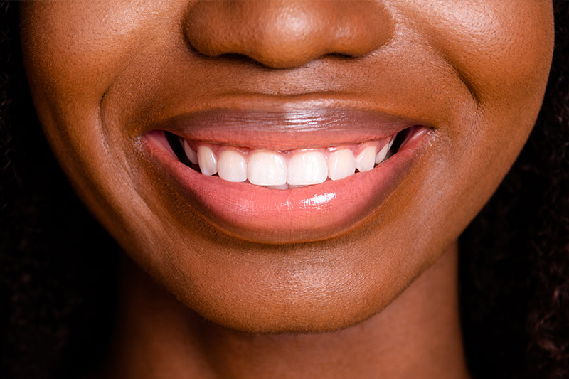 Dental Bonding LaGrange Park