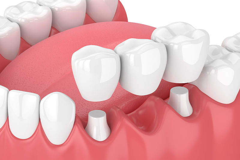 Dental Bridges LaGrange Park