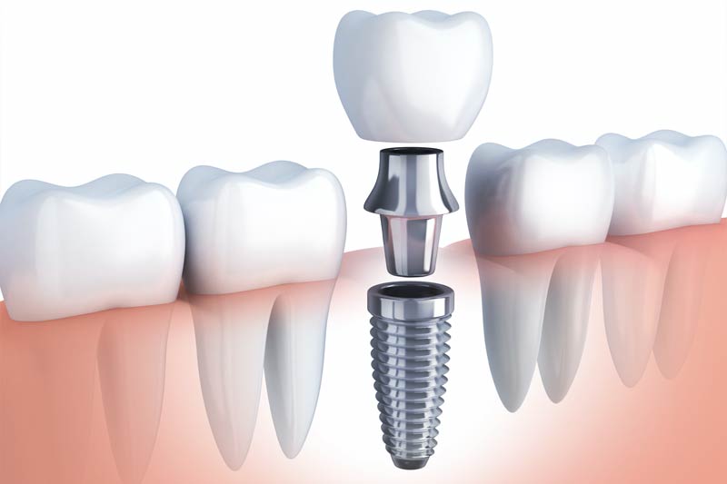 Implant Dentist in LaGrange Park