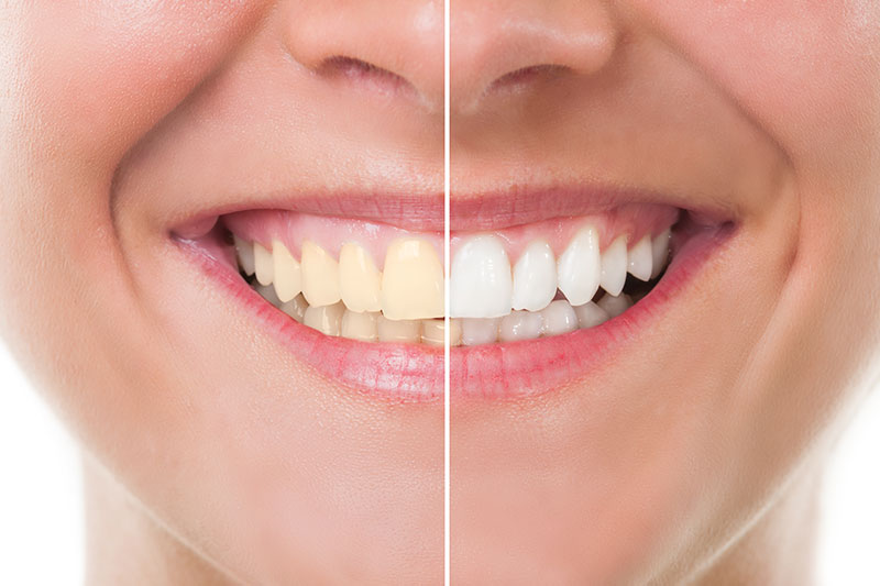 Teeth Whitening in LaGrange Park
